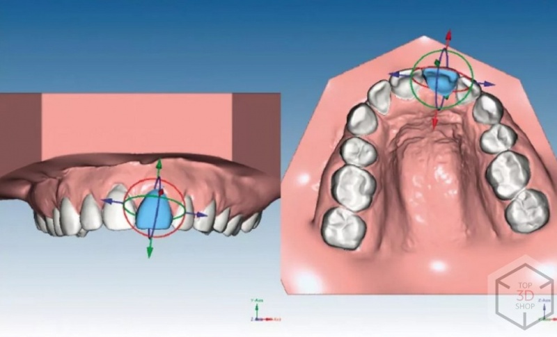 Моделирование плана лечения в CAD программе Maestro Ortho Studio