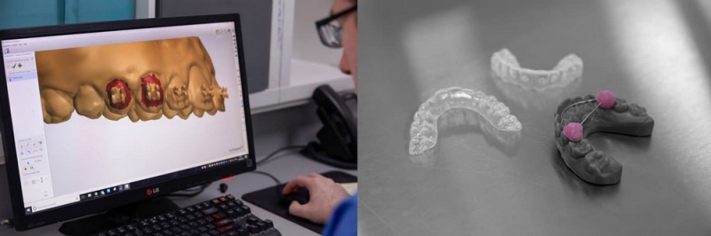 С помощью цифрового рабочего процесса техники могут снимать брекеты в цифровом виде и создавать несколько шин на одной и той же напечатанной 3D-модели.