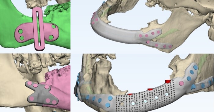 Процесс проектирования индивидуальной пластины для эндопротезирования нижней челюсти 