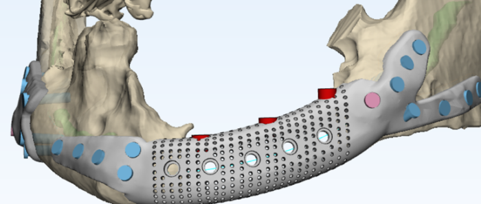  3D-модель пластины нижней челюсти 
