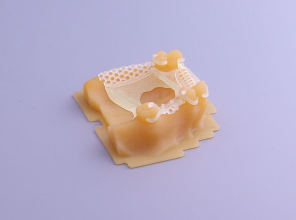 Модель из выжигаемого фотополимера Gorky Liquid Dental Castable на ортодонтической модели