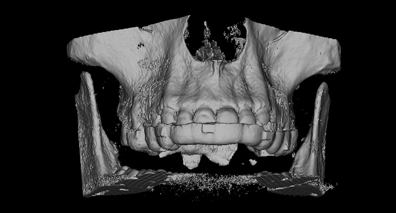 Рентгеноконтрастный фотополимер HARZ Labs Dental RO