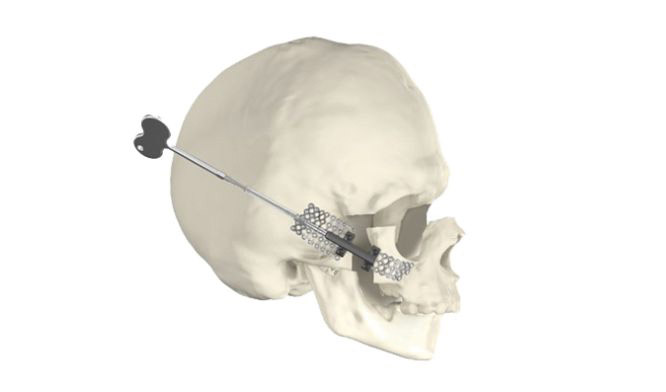 Рис. 6. Пример использования системы дистракции для удлинения лицевой кости черепа