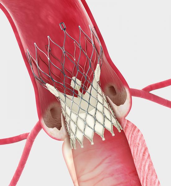  Рис. 16. Схема имплантации стент-клапана на нитиноловом каркасе в позицию аортального клапана