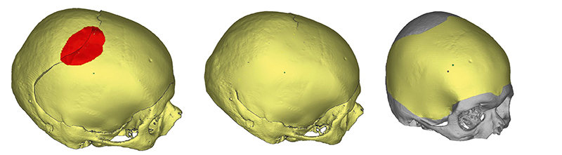  Рис. 9. Формирование полной модели черепа пациента, восстанавливающей область дефекта и точно повторяющей его форму до травмы