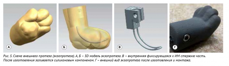 Рис. 5. Схема внешнего протеза (экзопротеза). А, Б – 3D модель экзопротеза. В – внутренняя фиксирующаяся к ИМ стержню часть. После изготовления заливается силиконовым компоненом. Г – внешний вид экзопротеза после изготовления и монтажа.