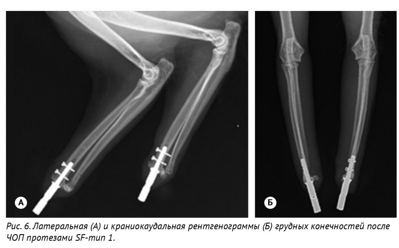 Рис. 6. Латеральная (А) и краниокаудальная рентгенограммы (Б) грудных конечностей после ЧОП протезами SF-тип 1.