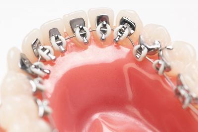 Рис. 3. Система зубных брекетов с напечатанными изделиями 