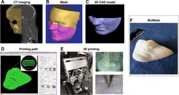 BioMask – напечатанная на 3D-принтере маска для лечения травм и ожогов лица 