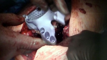 3d-печатный имплантат тазовой кости