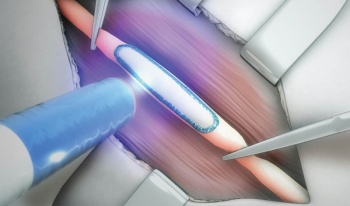 TISSIUM receives FDA approval for its polymerizable vascular sealant