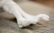 3D медицина и операции - печать на кости - реальный опыт 