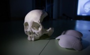 Новосибирские хирурги провели уникальную операцию по реконструкции черепа