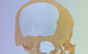 Пациенту успешно восстановили череп с помощью распечатанных на 3D-принтере костей