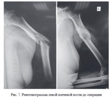 Хирургическое лечение пациентов с опухолями длинных трубчатых костей верхних конечностей с использованием индивидуальных имплантатов из костнозамещающего материала, созданных по технологиям 3D-печати