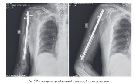 Хирургическое лечение пациентов с опухолями длинных трубчатых костей верхних конечностей с использованием индивидуальных имплантатов из костнозамещающего материала, созданных по технологиям 3D-печати